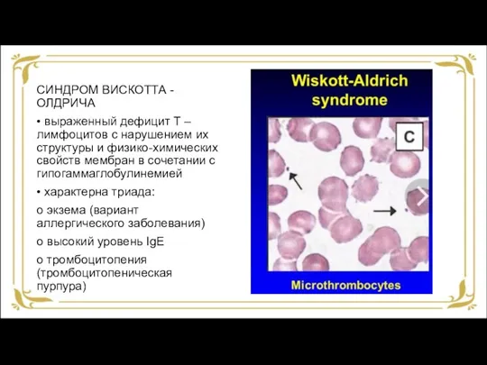 СИНДРОМ ВИСКОТТА - ОЛДРИЧА • выраженный дефицит Т – лимфоцитов с нарушением