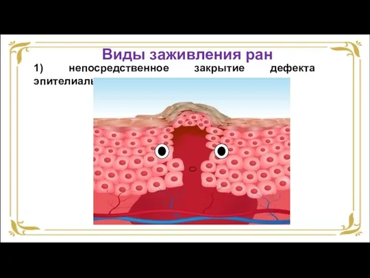 1) непосредственное закрытие дефекта эпителиального покрова; Виды заживления ран