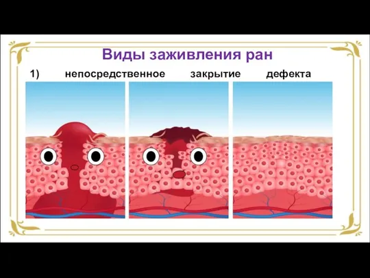 1) непосредственное закрытие дефекта эпителиального покрова; Виды заживления ран