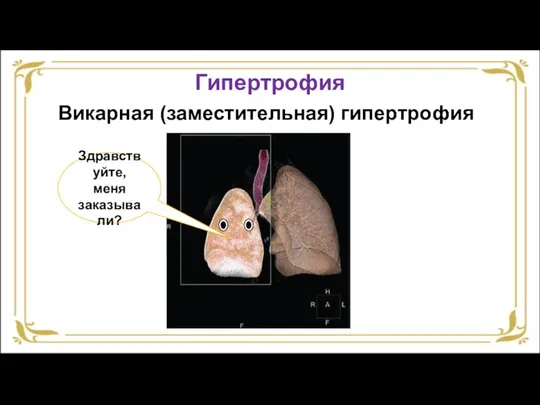 Гипертрофия Викарная (заместительная) гипертрофия Здравствуйте, меня заказывали?