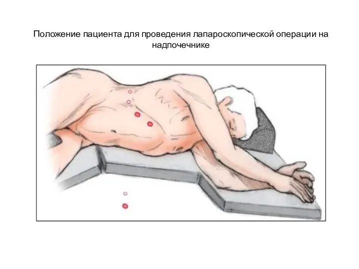 Положение пациента для проведения лапароскопической операции на надпочечнике