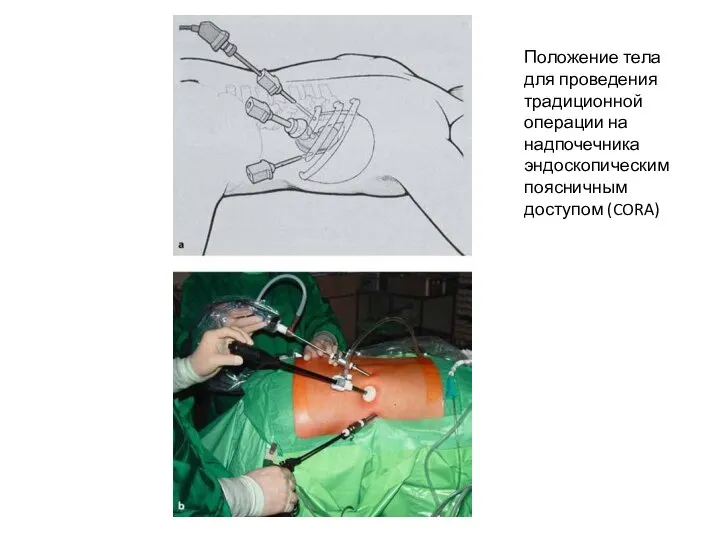 Положение тела для проведения традиционной операции на надпочечника эндоскопическим поясничным доступом (CORA)