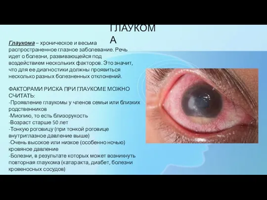 ГЛАУКОМА Глаукома – хроническое и весьма распространенное глазное заболевание. Речь идет о