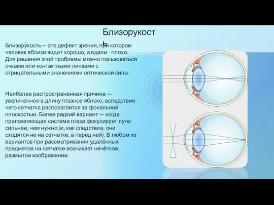 Близорукость Близору́кость— это дефект зрения, при котором человек вблизи видит хорошо, а