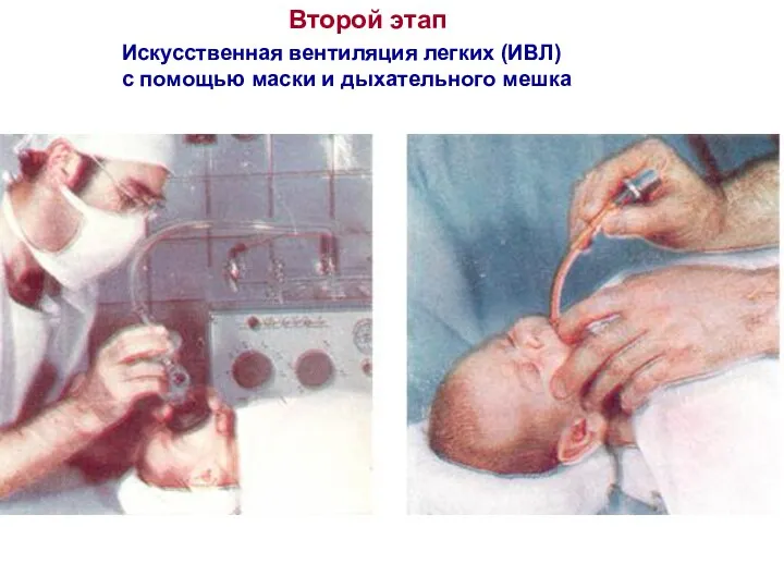 Искусственная вентиляция легких (ИВЛ) с помощью маски и дыхательного мешка Второй этап