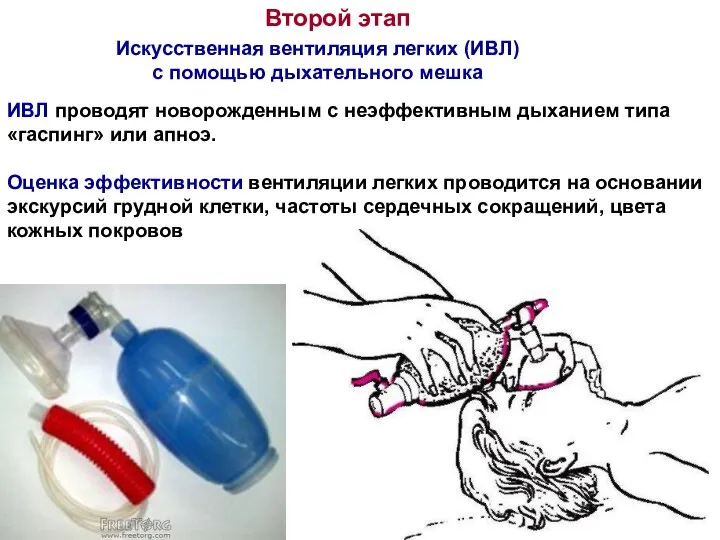 Искусственная вентиляция легких (ИВЛ) с помощью дыхательного мешка Второй этап ИВЛ проводят