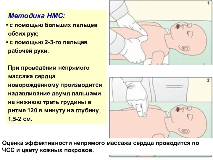 Методика НМС: с помощью больших пальцев обеих рук; с помощью 2-3-го пальцев