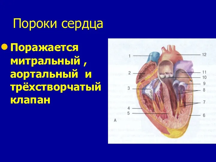 Пороки сердца Поражается митральный , аортальный и трёхстворчатый клапан