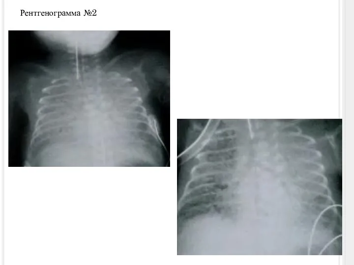 Рентгенограмма №2