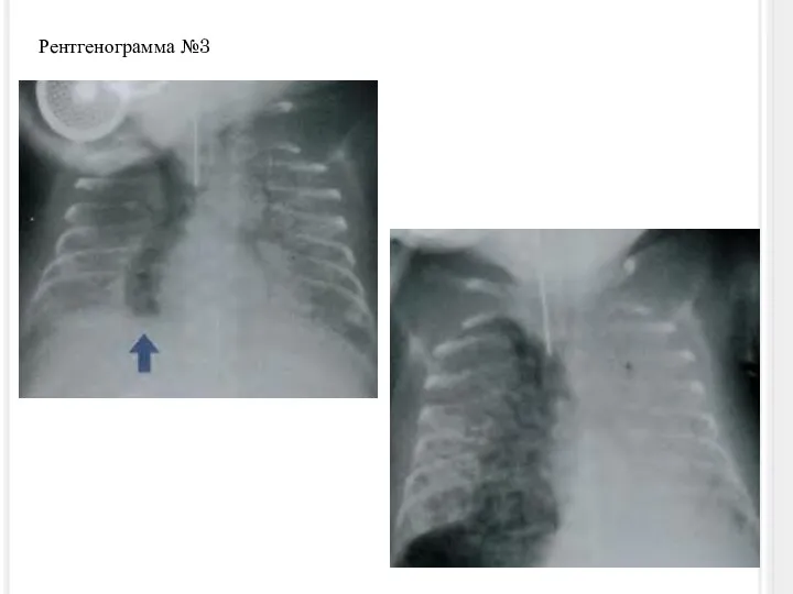 Рентгенограмма №3