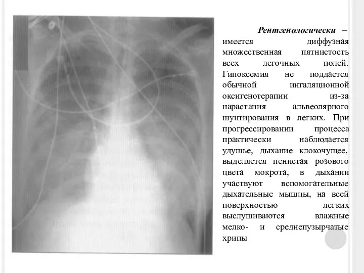 Рентгенологически – имеется диффузная множественная пятнистость всех легочных полей. Гипоксемия не поддается