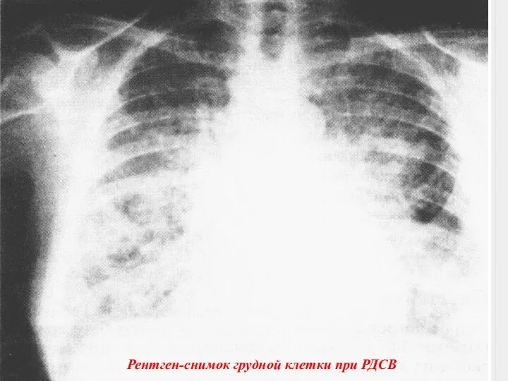 Рентген-снимок грудной клетки при РДСВ