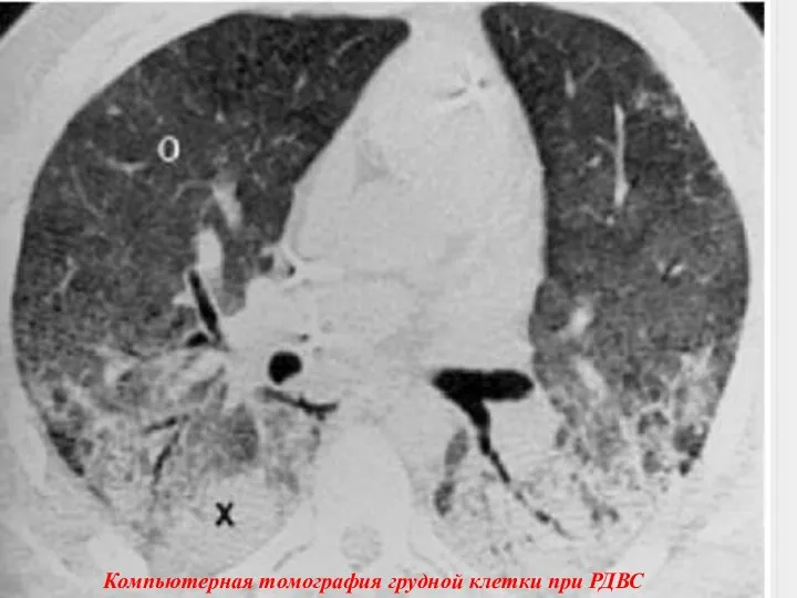 Компьютерная томография грудной клетки при РДВС