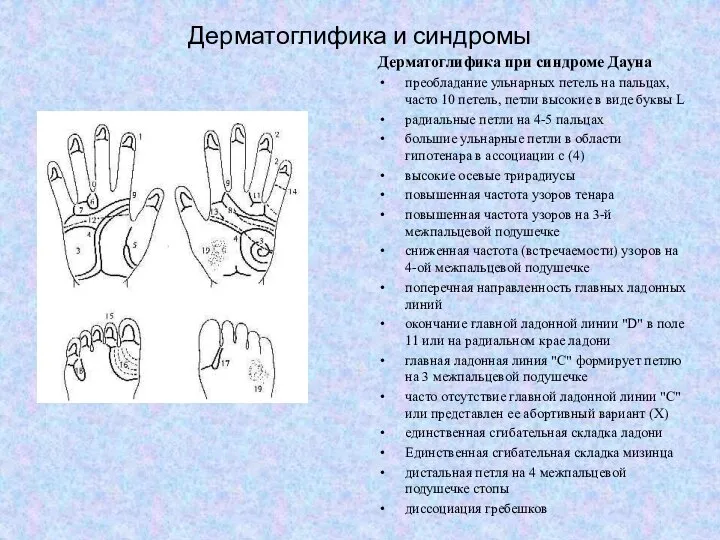 Дерматоглифика и синдромы Дерматоглифика при синдроме Дауна преобладание ульнарных петель на пальцах,