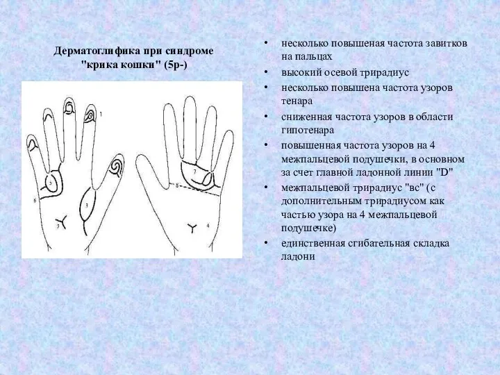 Дерматоглифика при синдроме "крика кошки" (5р-) несколько повышеная частота завитков на пальцах