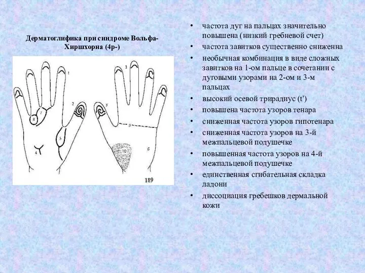 Дерматоглифика при синдроме Вольфа-Хиршхорна (4р-) частота дуг на пальцах значительно повышена (низкий