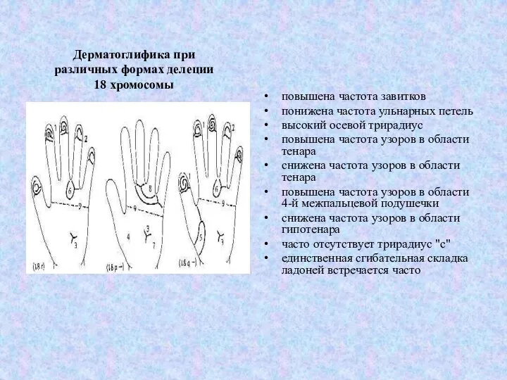 Дерматоглифика при различных формах делеции 18 хромосомы повышена частота завитков понижена частота