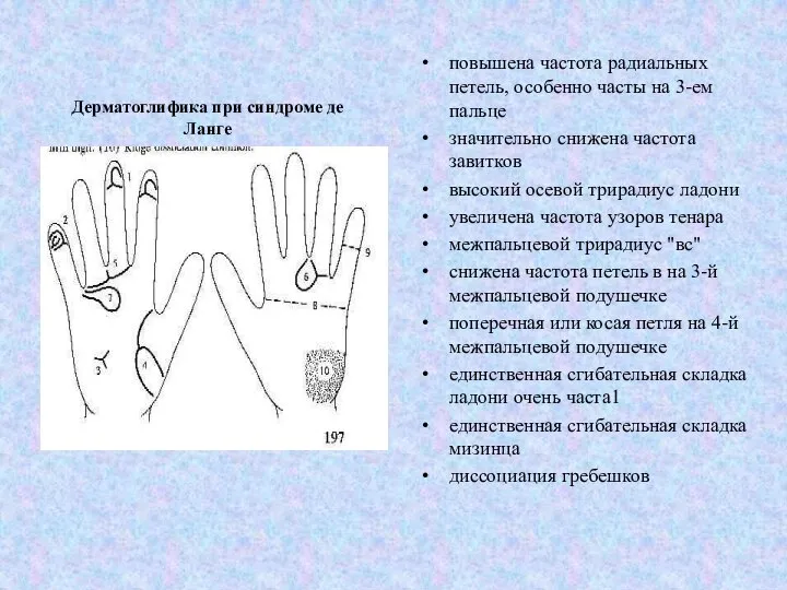 Дерматоглифика при синдроме де Ланге повышена частота радиальных петель, особенно часты на