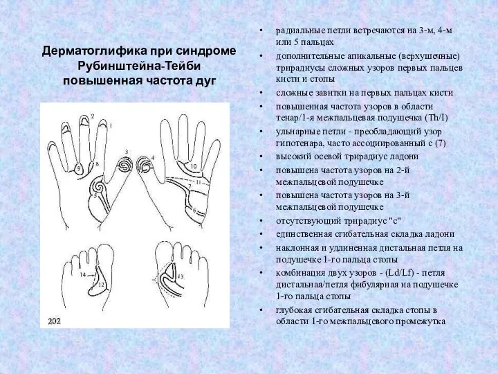 Дерматоглифика при синдроме Рубинштейна-Тейби повышенная частота дуг радиальные петли встречаются на 3-м,