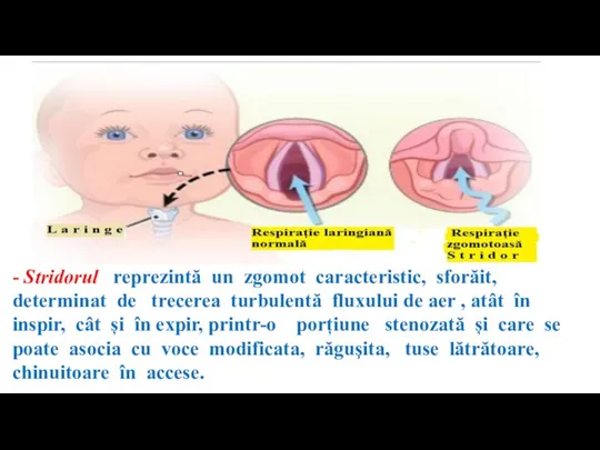 - Stridorul reprezintă un zgomot caracteristic, sforăit, determinat de trecerea turbulentă fluxului