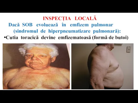 INSPECȚIA LOCALĂ Dacă SOB evoluează în emfizem pulmonar (sindromul de hiperpneumatizare pulmonară):