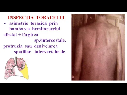 INSPECŢIA TORACELUI asimetrie toracică prin bombarea hemitoracelui afectat + lărgirea sp./intercostale, protruzia sau denivelarea spaţiilor intervertebrale