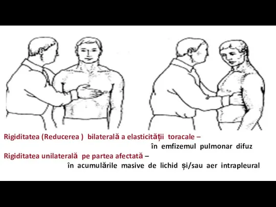 Rigiditatea (Reducerea ) bilaterală a elasticității toracale – în emfizemul pulmonar difuz