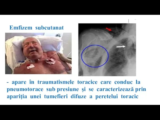 Emfizem subcutanat - apare în traumatismele toracice care conduc la pneumotorace sub