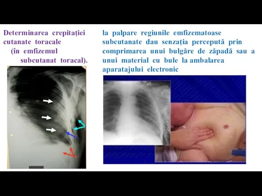 Determinarea crepitației cutanate toracale (în emfizemul subcutanat toracal). la palpare regiunile emfizematoase