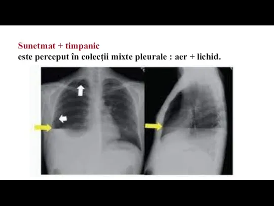 Sunetmat + timpanic este perceput în colecţii mixte pleurale : aer + lichid.