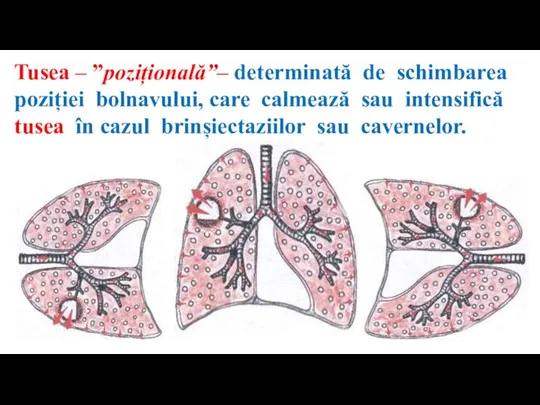 Tusea – ”pozițională”– determinată de schimbarea poziției bolnavului, care calmează sau intensifică