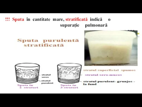 !!! Sputa în cantitate mare, stratificată indică o supuraţie pulmonară