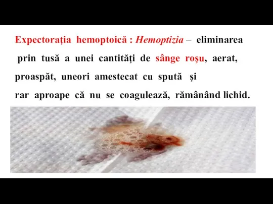 Expectoraţia hemoptoică : Hemoptizia – eliminarea prin tusă a unei cantităţi de