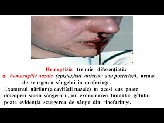 Hemoptizia trebuie diferențiată: hemoragiile nazale (epistaxisul anterior sau posterior), urmat de scurgerea