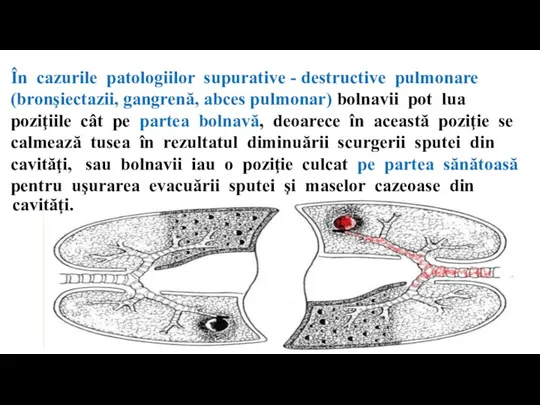 În cazurile patologiilor supurative - destructive pulmonare (bronşiectazii, gangrenă, abces pulmonar) bolnavii