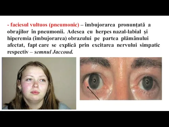 - faciesul vultuos (pneumonic) – îmbujorarea pronunţată a obrajilor în pneumonii. Adesea