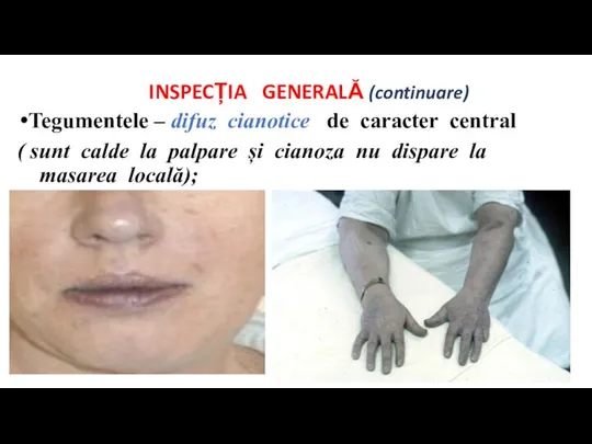 INSPECȚIA GENERALĂ (continuare) Tegumentele – difuz cianotice de caracter central ( sunt