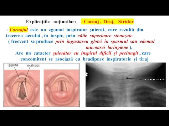 Explicațiile noțiunilor: - Cornaj , Tiraj, Stridor - Cornajul este un zgomot