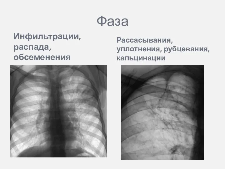 Фаза Инфильтрации, распада, обсеменения Рассасывания, уплотнения, рубцевания, кальцинации