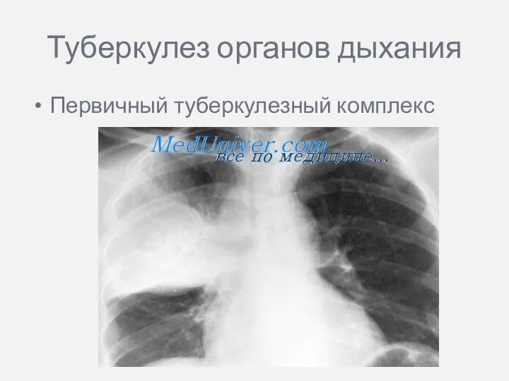 Туберкулез органов дыхания Первичный туберкулезный комплекс