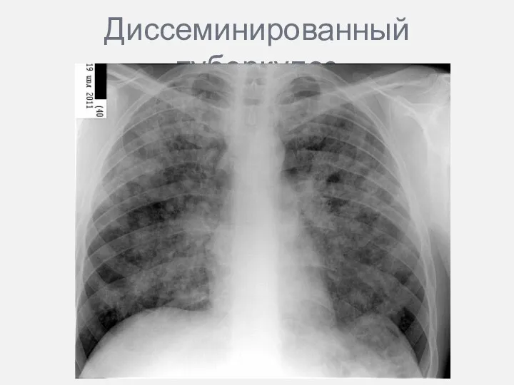 Диссеминированный туберкулез