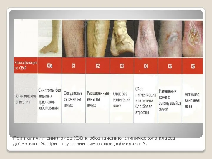 При наличии симптомов ХЗВ к обозначению клинического класса добавляют S. При отсутствии симптомов добавляют А.