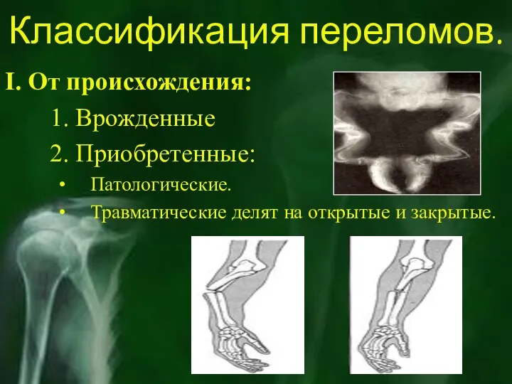 Классификация переломов. I. От происхождения: 1. Врожденные 2. Приобретенные: Патологические. Травматические делят на открытые и закрытые.