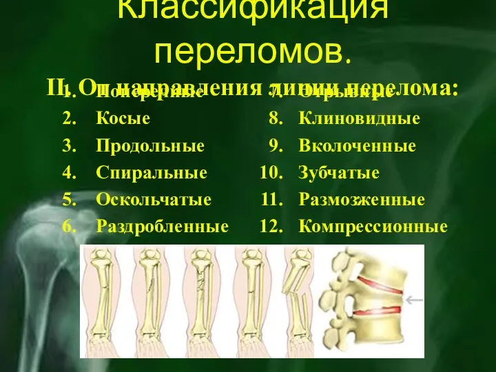 Классификация переломов. II. От направления линии перелома: Поперечные Косые Продольные Спиральные Оскольчатые