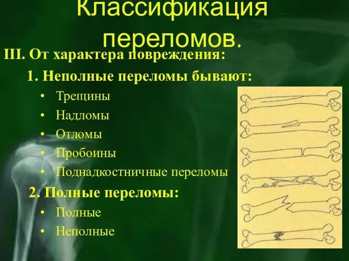 Классификация переломов. III. От характера повреждения: 1. Неполные переломы бывают: Трещины Надломы