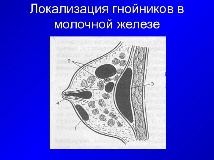 Локализация гнойников в молочной железе