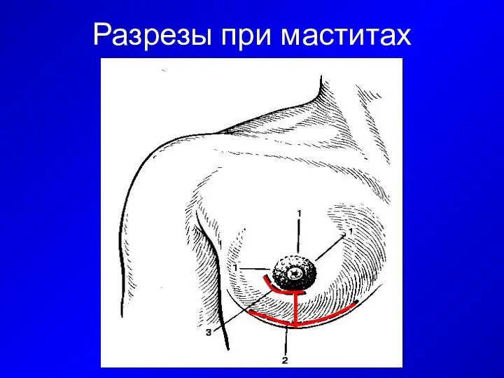 Разрезы при маститах