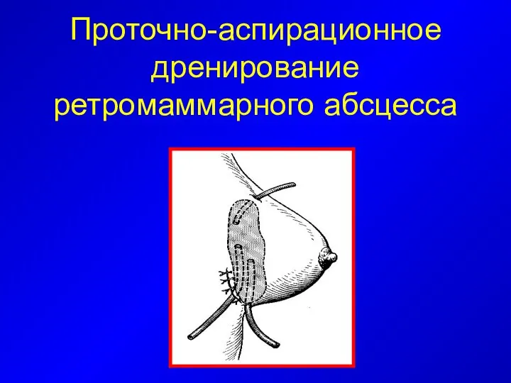 Проточно-аспирационное дренирование ретромаммарного абсцесса