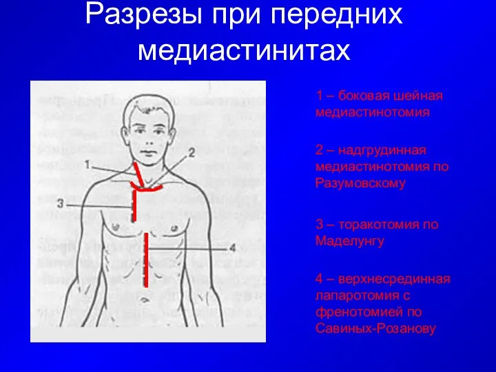 Разрезы при передних медиастинитах 4 – верхнесрединная лапаротомия с френотомией по Савиных-Розанову