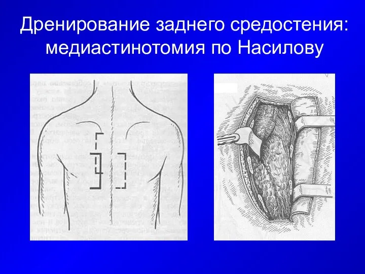 Дренирование заднего средостения: медиастинотомия по Насилову